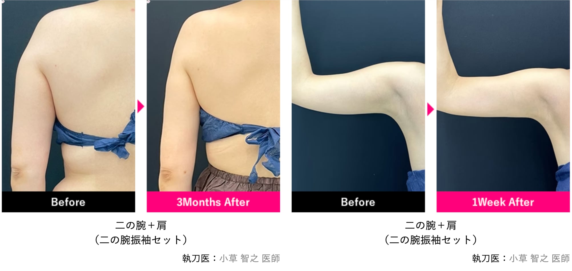 二の腕振袖セット（二の腕＋肩・二の腕付け根）※それぞれ脇の傷から10cmの範囲
