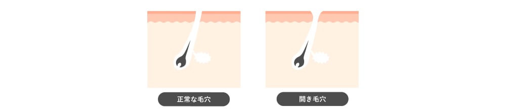 開き毛穴 