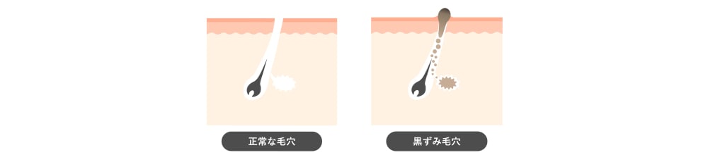 黒ずみ毛穴（いちご鼻）