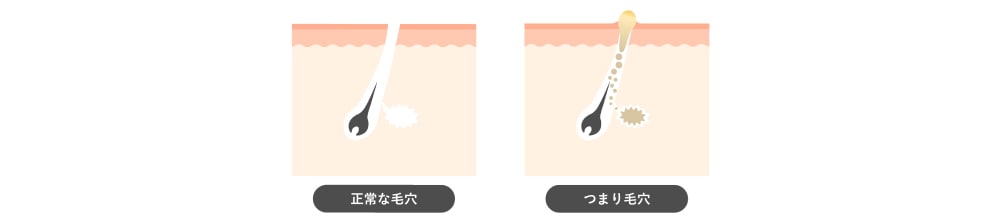 毛穴詰まり<br />
