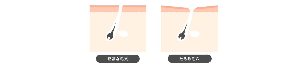 毛穴のたるみ 