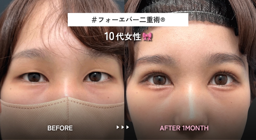 2.圧倒的な変化量の華やかな幅広めMIX型二重