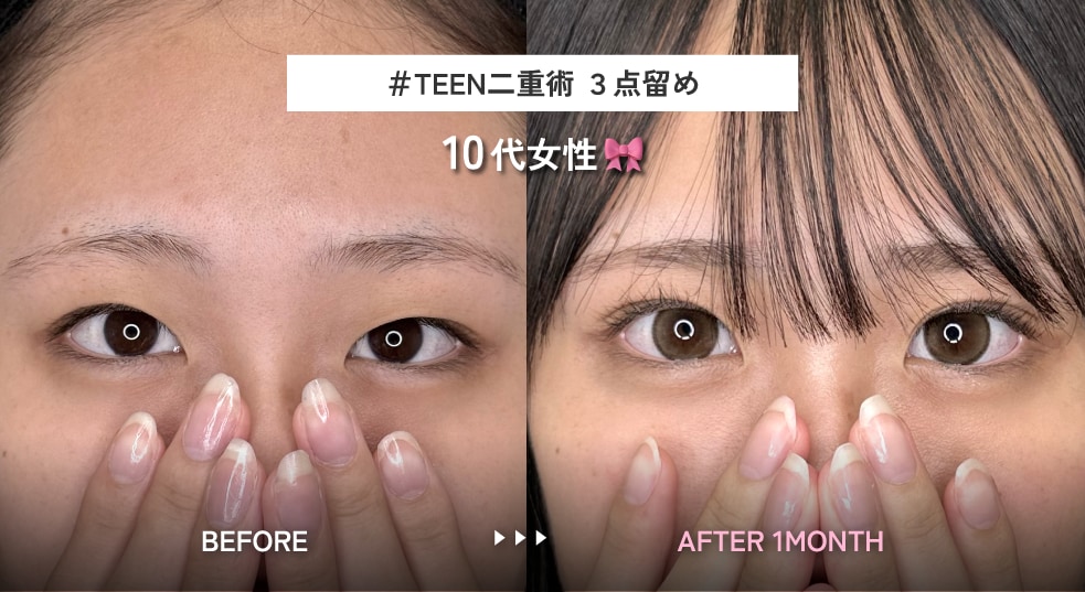 3.学校でもバレない！ナチュラル末広型二重
