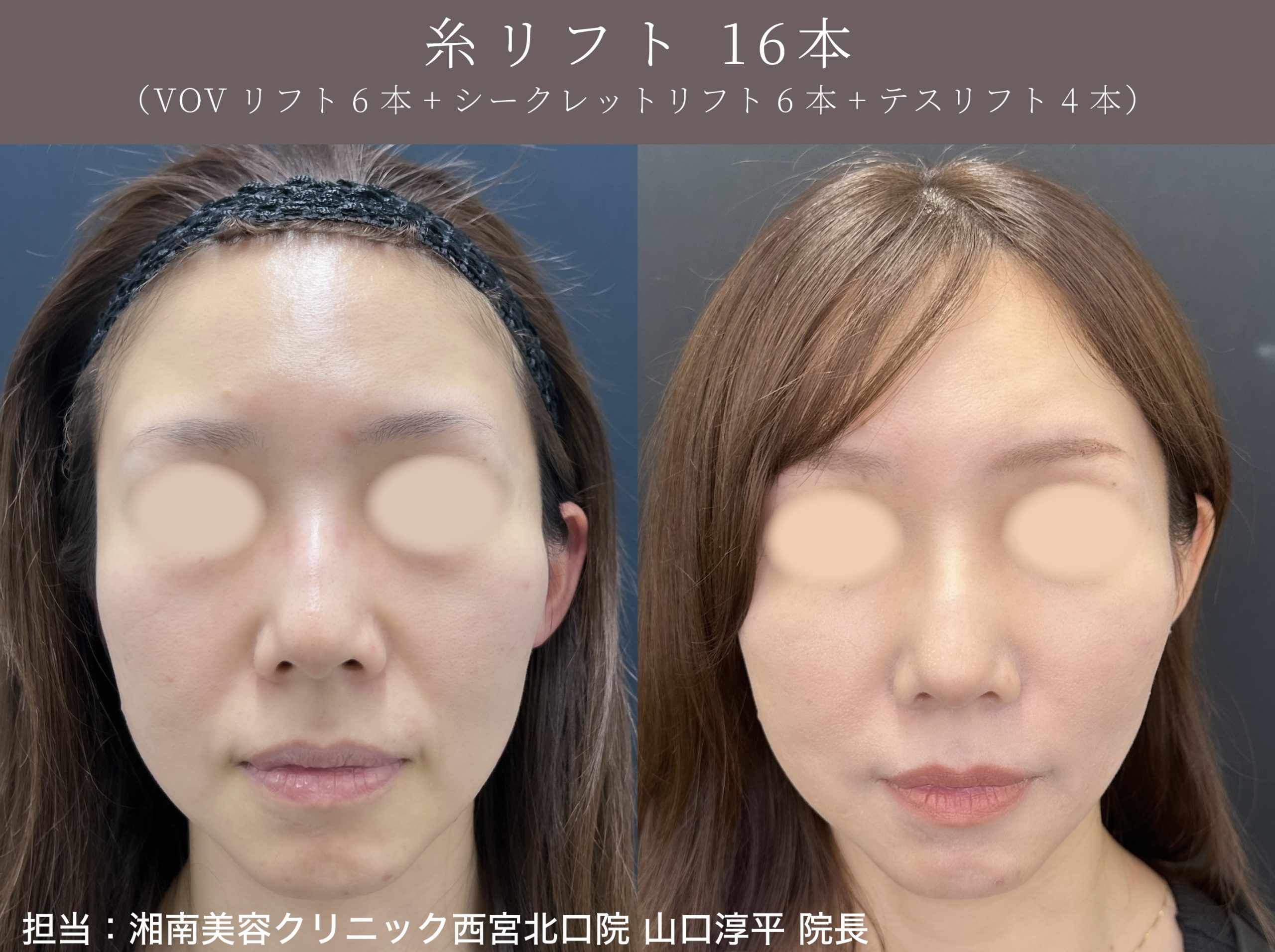 ・糸リフト