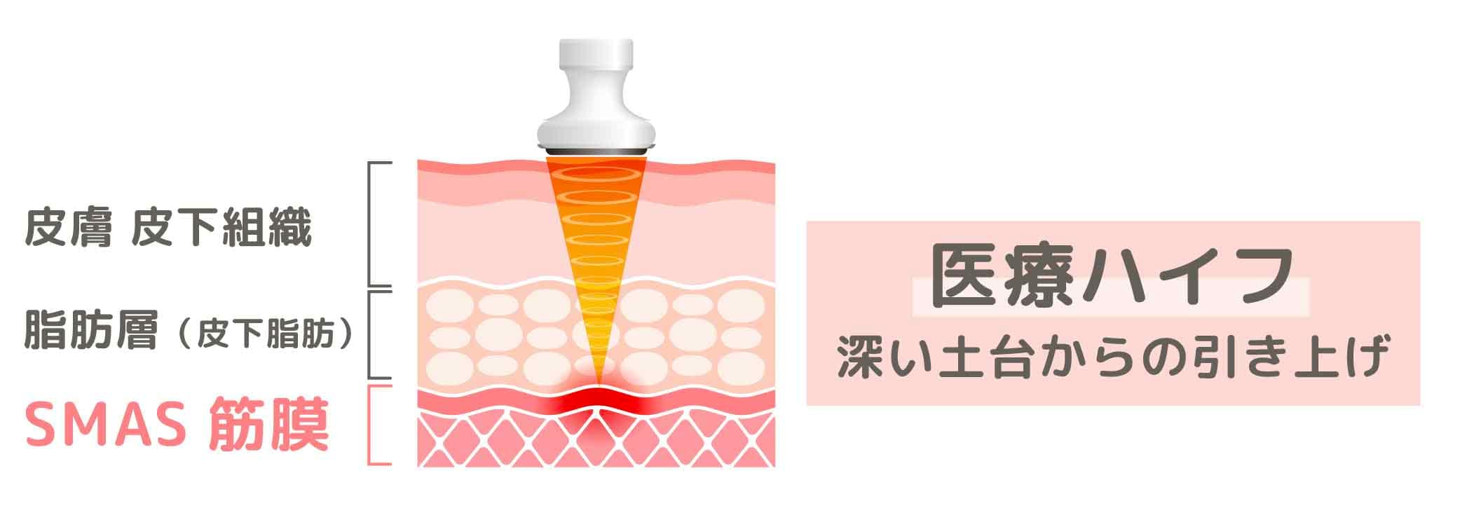 1. 医療ハイフ（HIFU）：深い土台（SMAS筋膜）を引き上げる