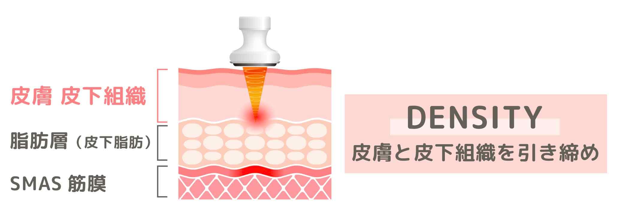 2. デンシティ（DENSITY）：真皮・皮下組織を面で引き締める