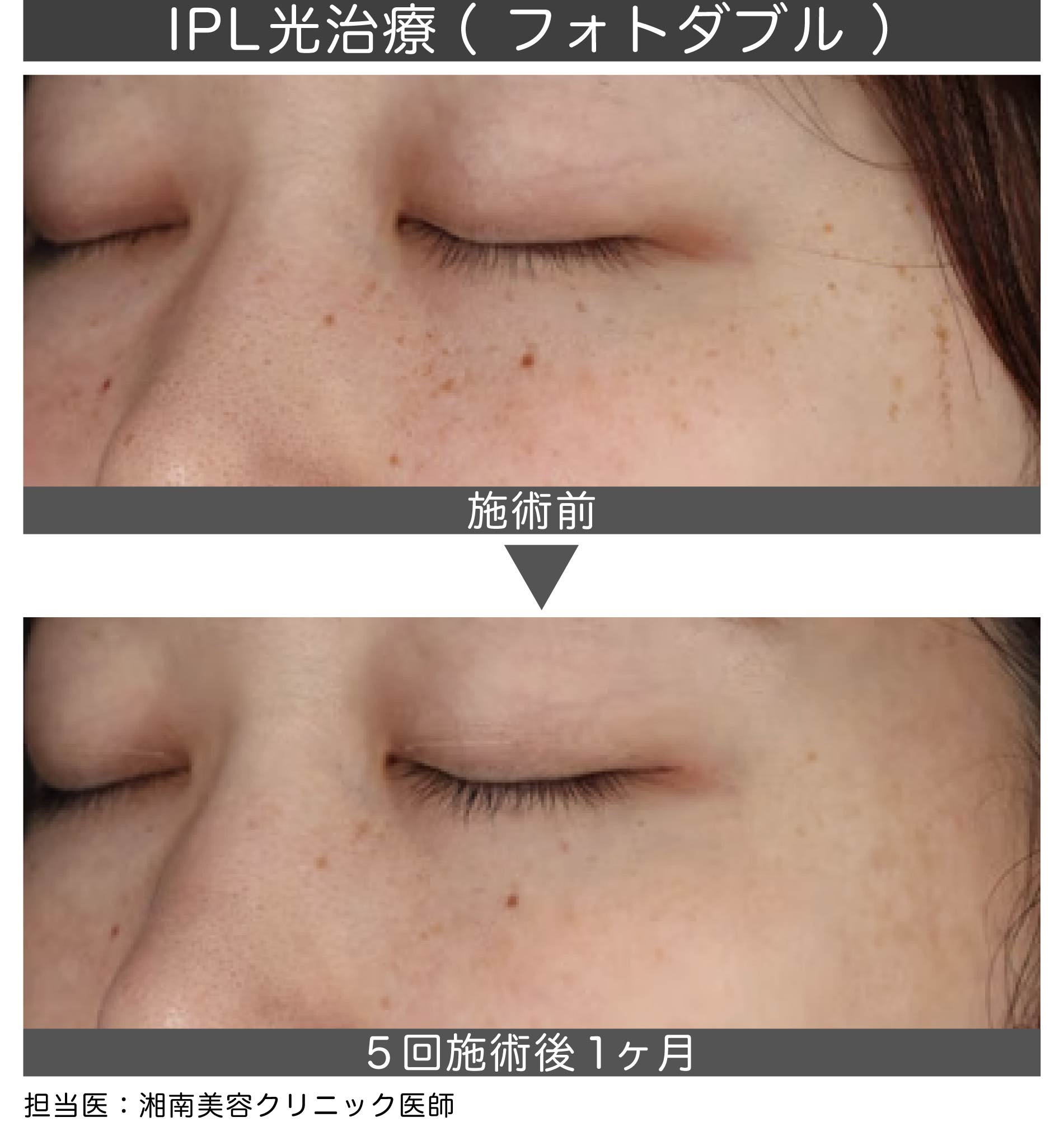 IPL=Intense Pulsed Light