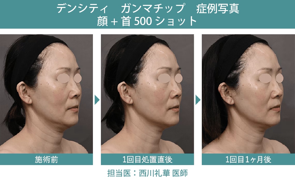 デンシティがもたらすキュッと引き締まったフェイスライン