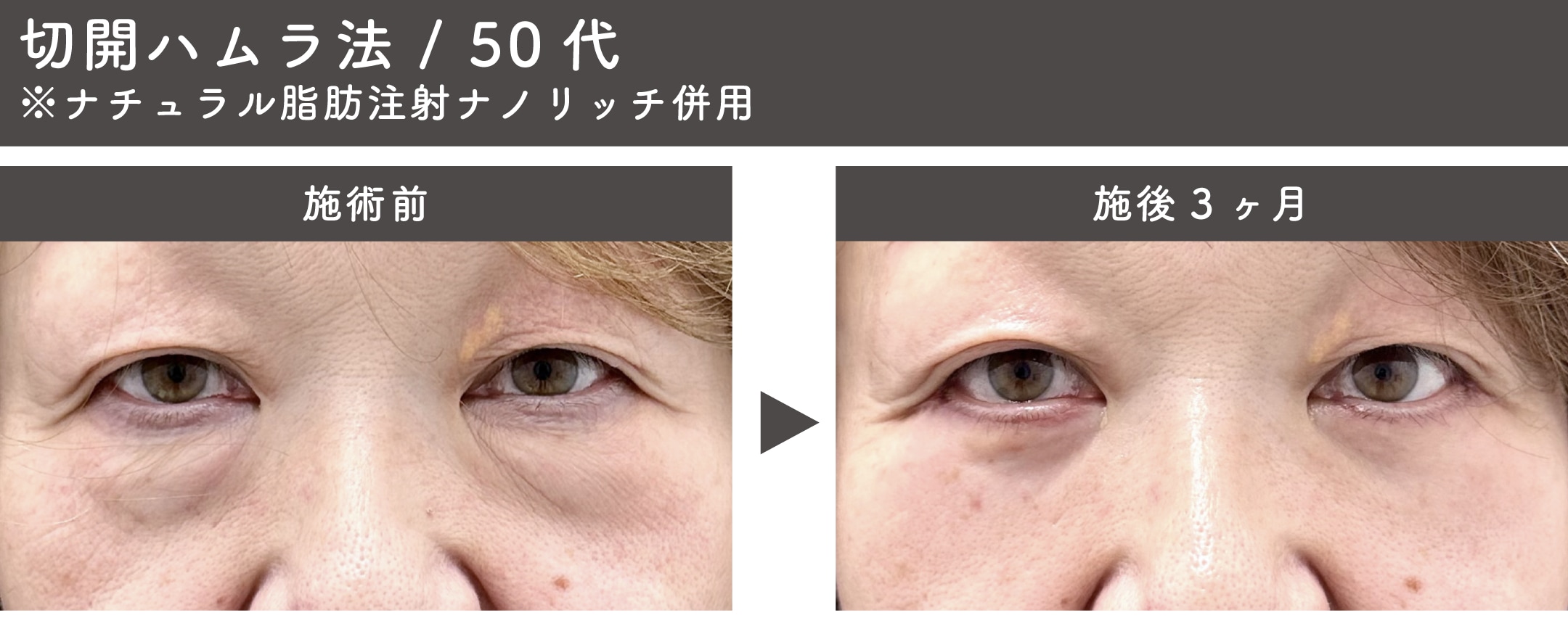 切開ハムラ法