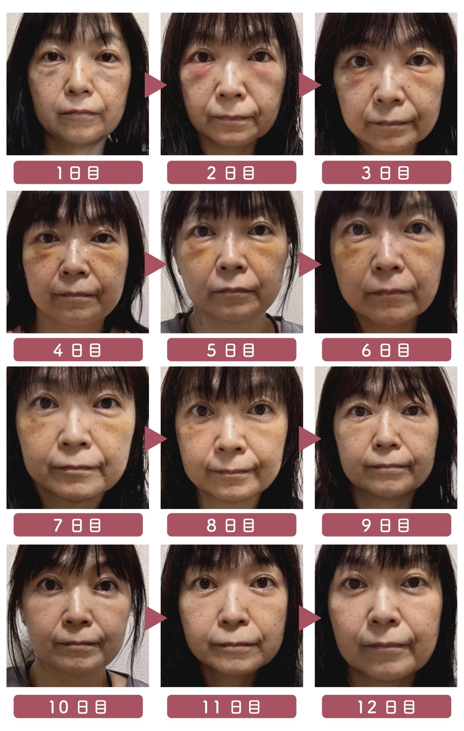 2〜3日目がピーク！1週間程度で徐々に落ち着く場合が多いです🙆‍♀️
