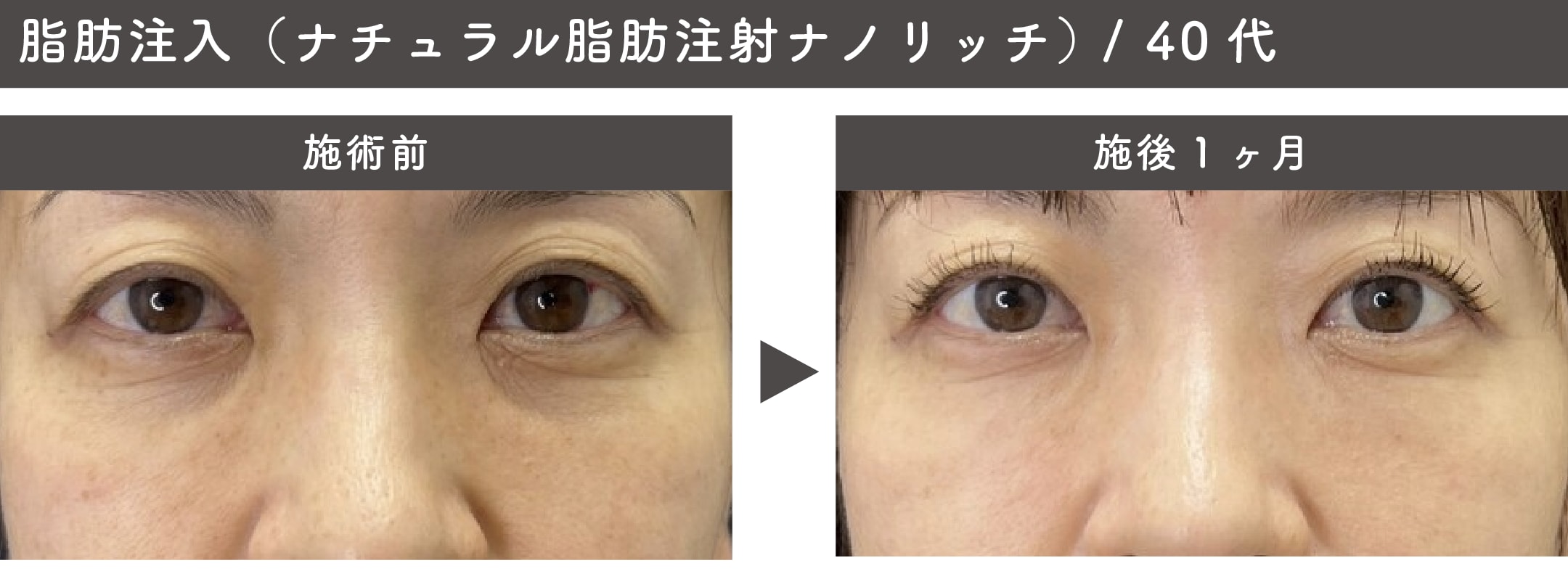 脂肪注入