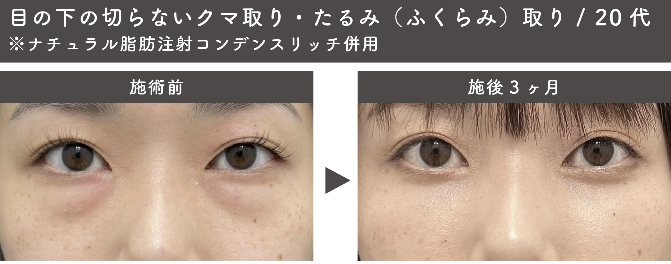 目の下の切らないクマ取り・たるみ（ふくらみ）取り<br />
