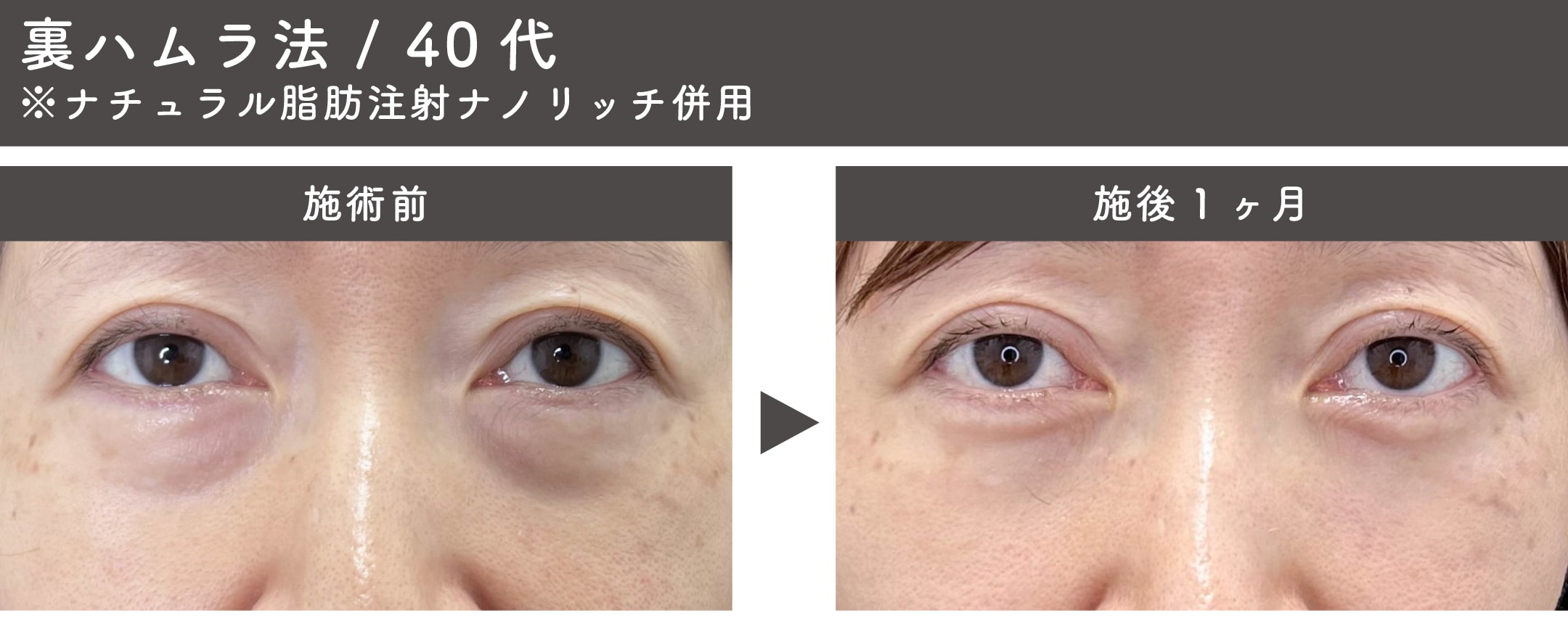 裏ハムラ法