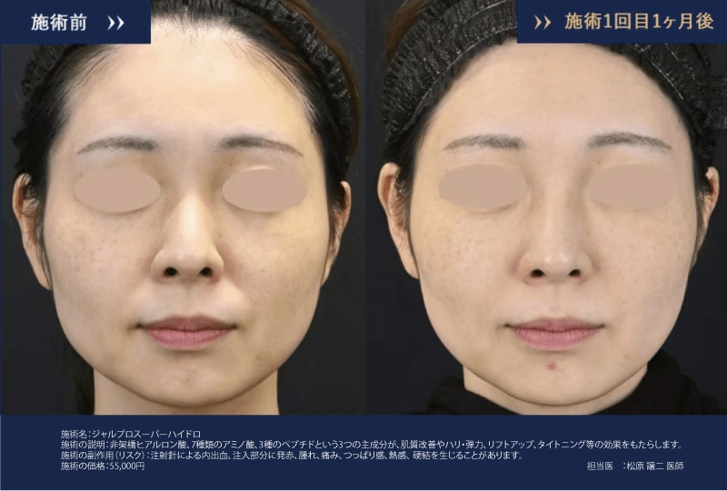 ジャルプロスーパーハイドロ症例写真1