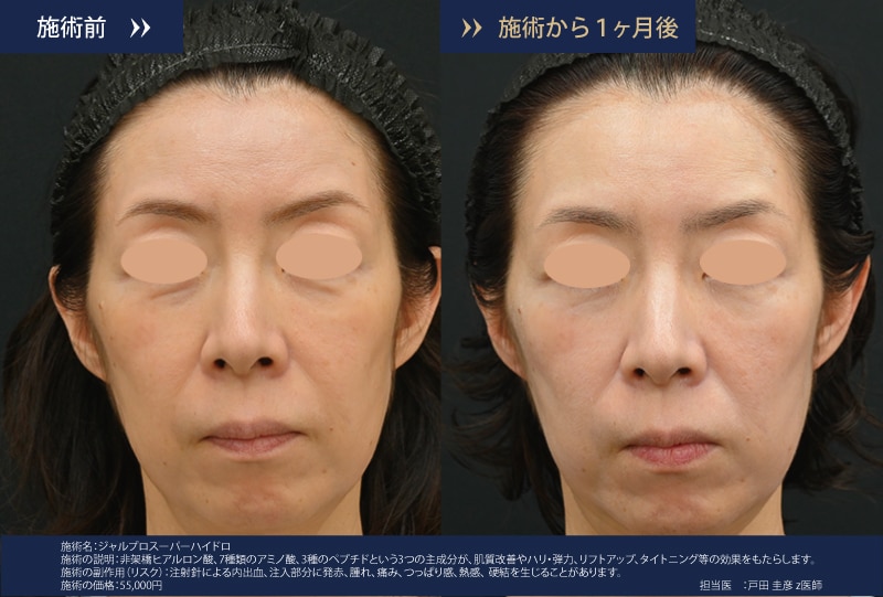 ジャルプロスーパーハイドロ症例写真2