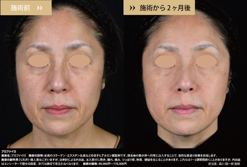 プロファイロ症例写真1