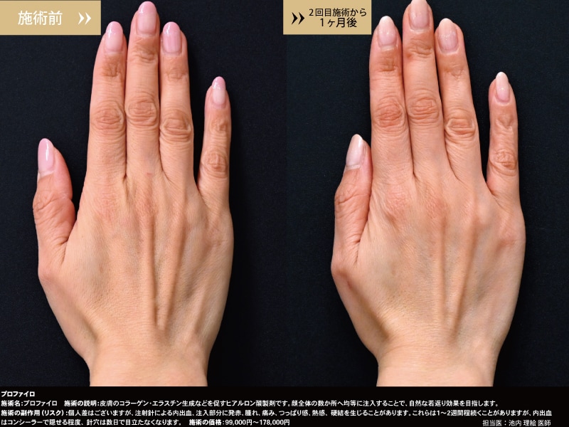 プロファイロ症例写真2