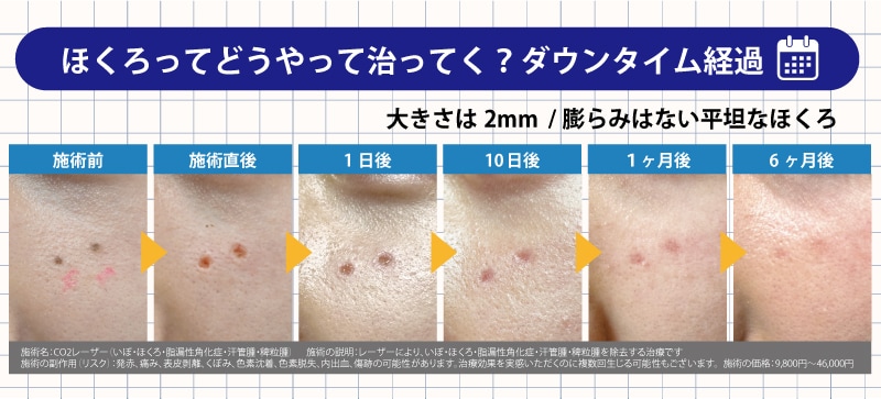 ほくろのダウンタイム経過
