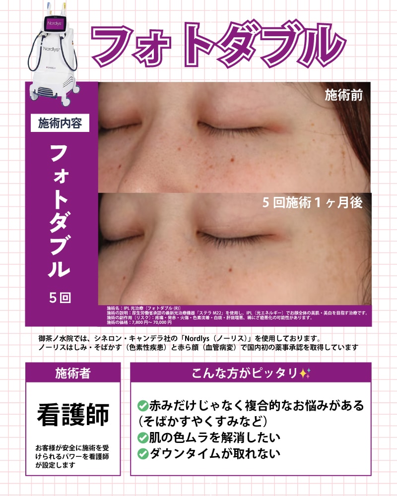 フォトダブル症例