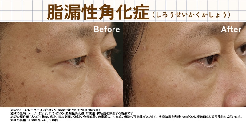 脂漏性角化症症例