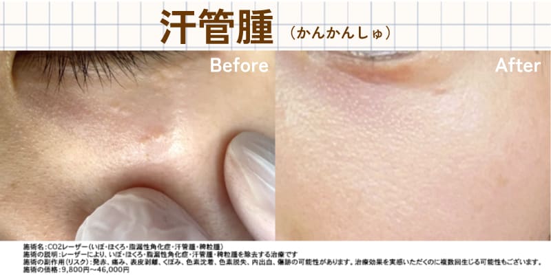 汗管腫症例