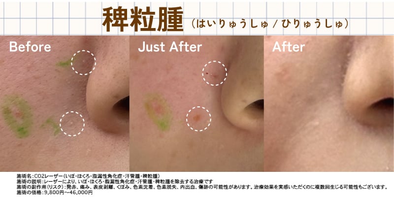 稗粒腫症例