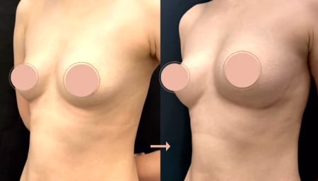 脂肪注入豊胸のダウンタイム