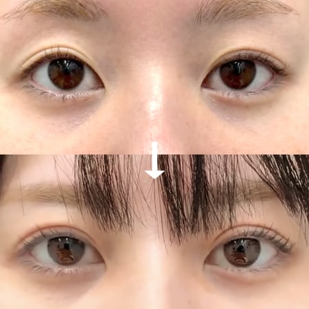 タルミ取り併用全切開法二重術