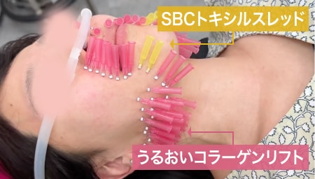 たるみとシワを切らずに、同時に改善できる施術