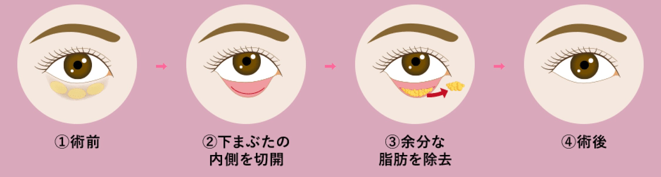 脱脂（目の下の切らないクマ取り）［軽度のたるみの場合］