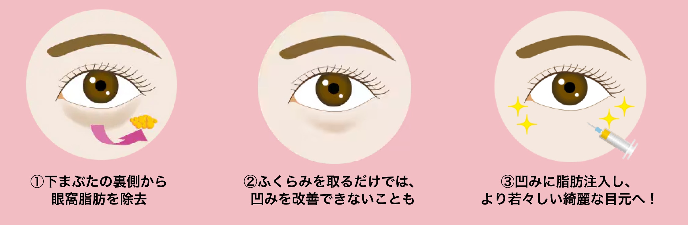 脱脂（目の下の切らないクマ取り）+脂肪注入［中度から重度のたるみの場合］
