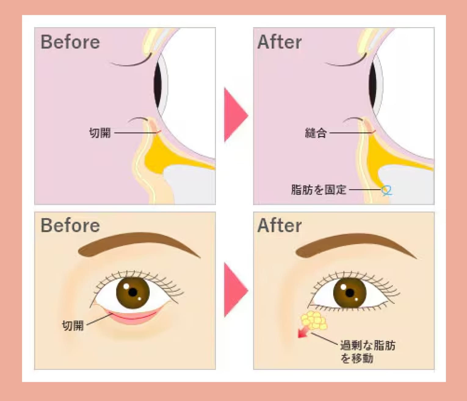 裏ハムラ法［膨らみと凹みがある場合］