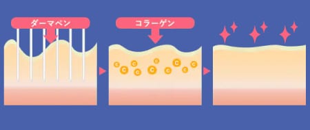 ダーマペンは何回受ければ効果が出る？
