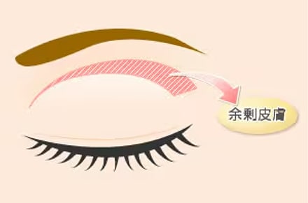 たるみ取り併用全切開法二重術