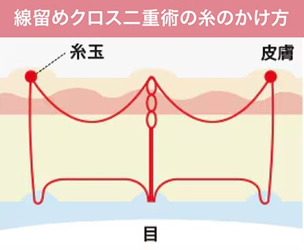 線留めクロス二重術