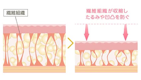 皮膚の「引き締め効果」でたるみ予防