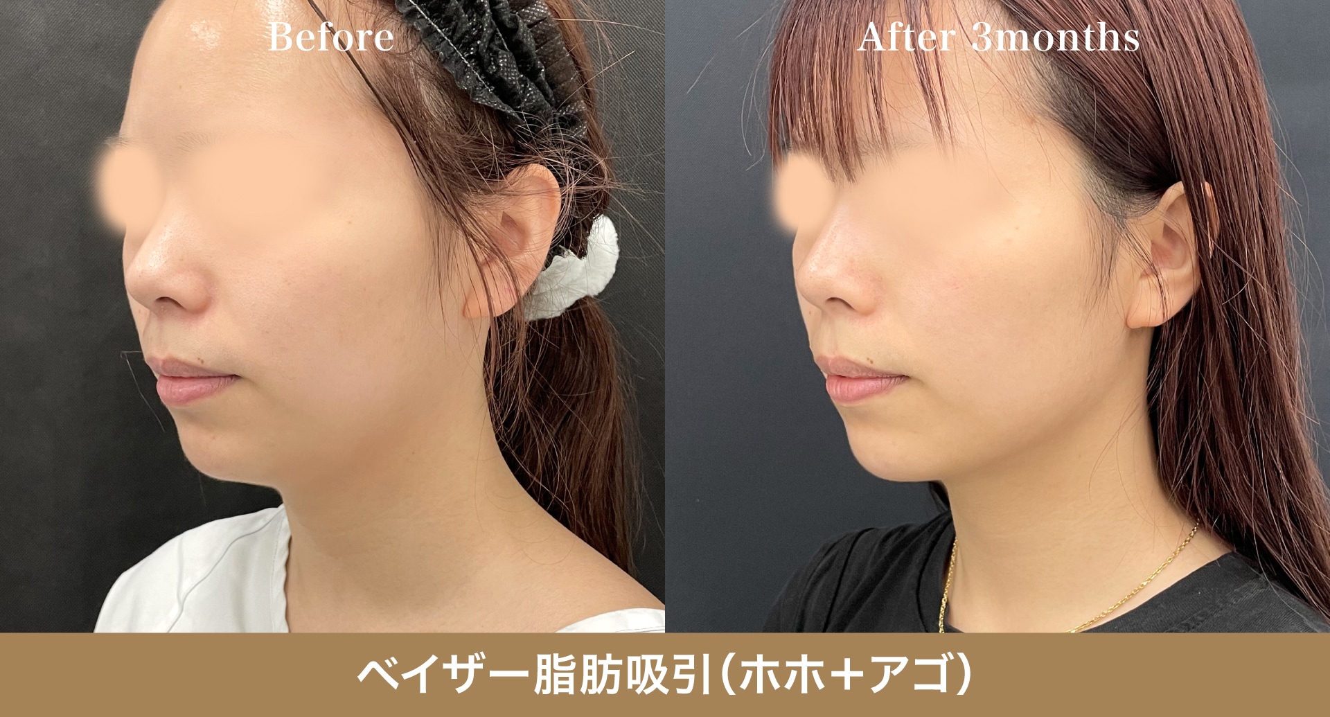 お顔：360度どこから見ても美しいEライン