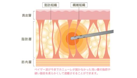 90%の脂肪を除去
