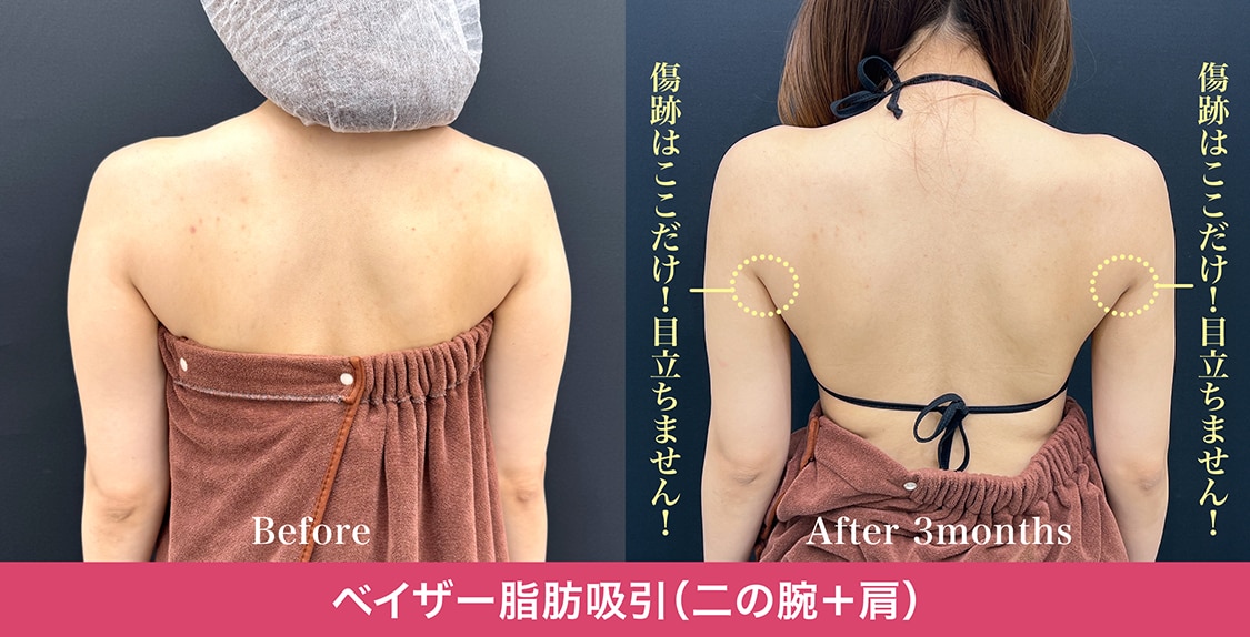  傷跡は「ワキの下」だけ！肘には傷を作りません