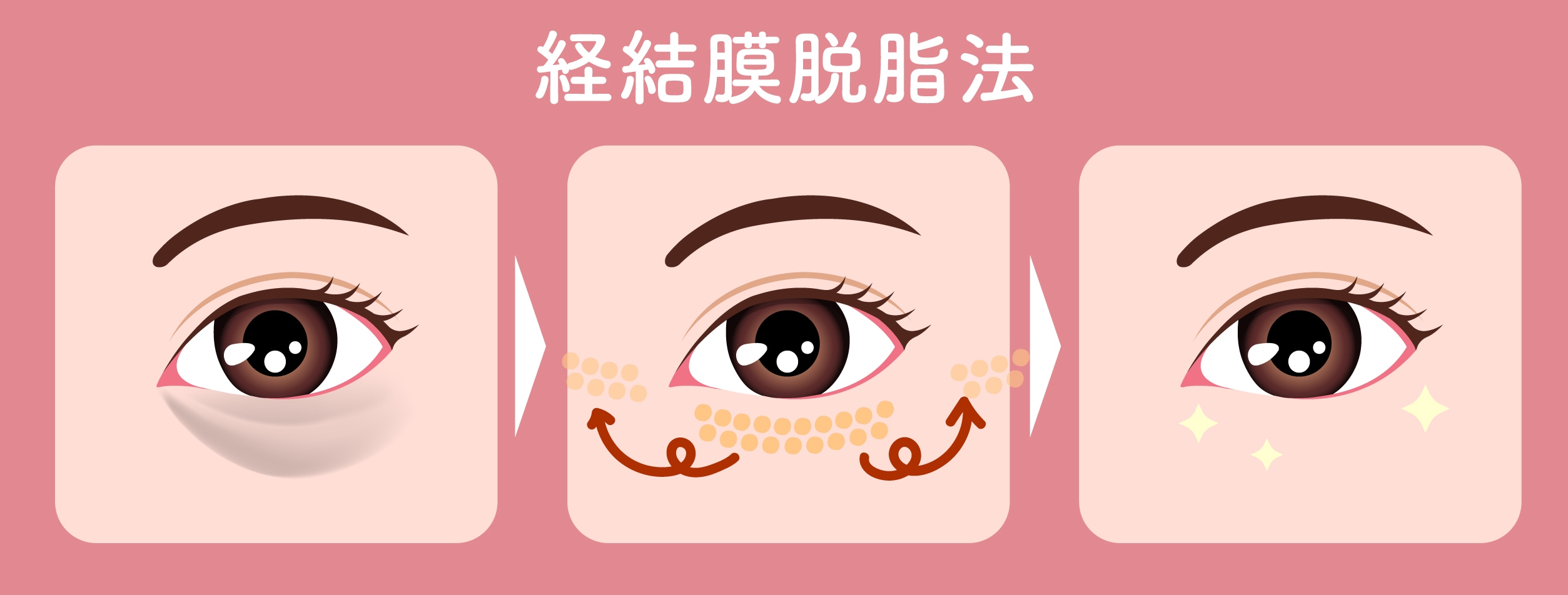 経結膜脱脂法（脱脂）＝脂肪を「除去する（捨てる）」