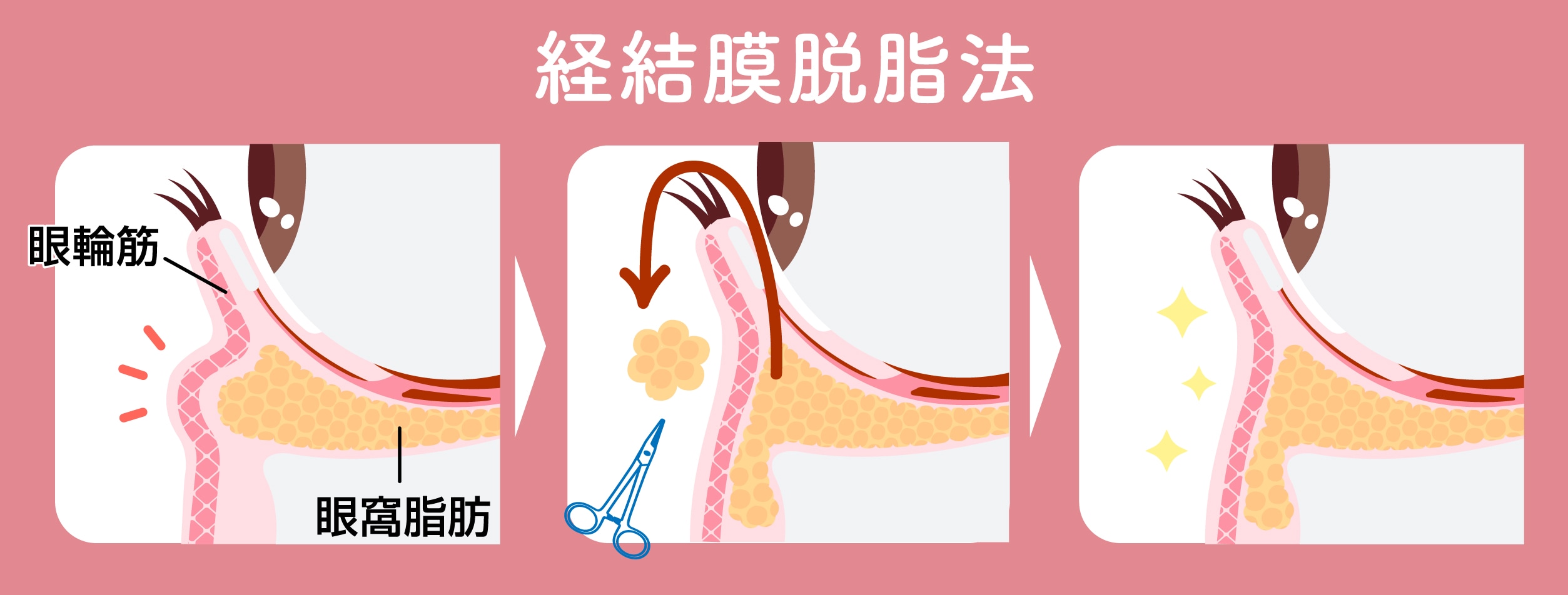 脱脂法のメリットとリスク