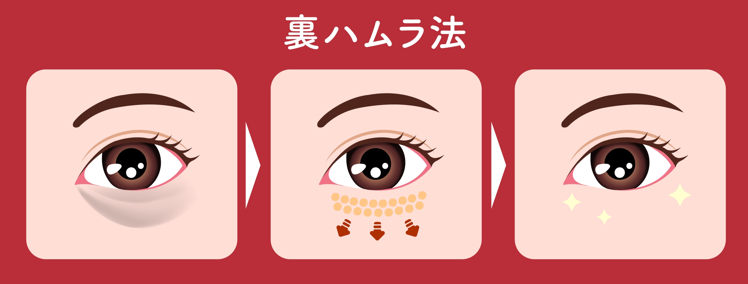 裏ハムラ法（脂肪再配置）＝脂肪を「移動する（再利用する）」