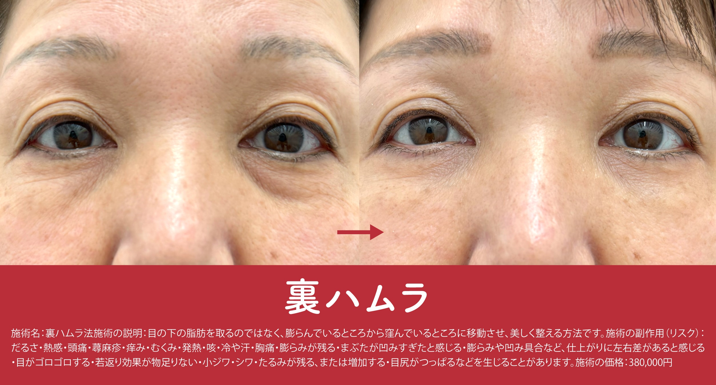 「脂肪を操る技術」を目元に応用する