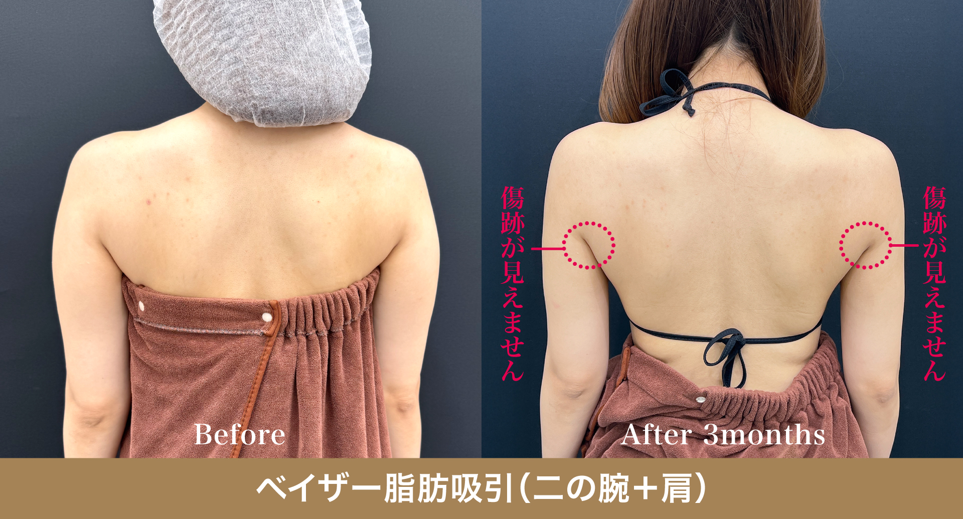 二の腕：傷跡は「ワキの下」だけ。肘に傷を作りません