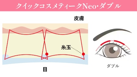 埋没法の常識を覆す！ダブルの糸が生む圧倒的な持続力