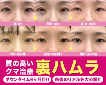 【完全密着】裏ハムラ法のダウンタイムは悲惨?術前〜半年後までのリアルな経過を大公開!