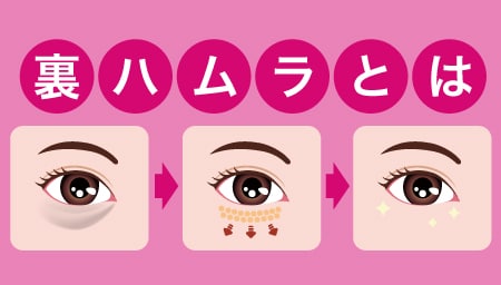 裏ハムラ法（経結膜的眼窩脂肪移動術）の最強メリット