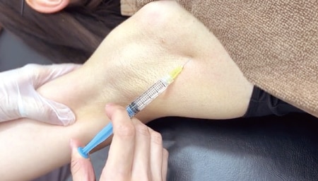 手軽さ重視！切らずにピタッと汗を止める「ワキ汗ボトックス」