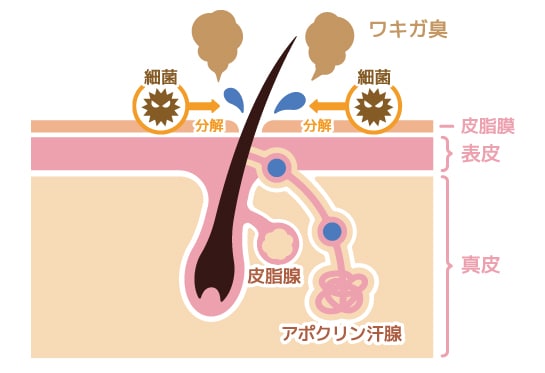 ニオイが強い「ワキガ（腋臭症）」