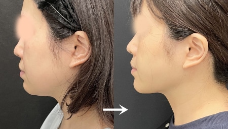 皮膚を「たるませない」引き締め効果